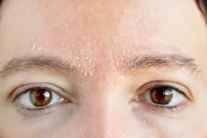 woman with Dry Skin - Causes of Dry Skin