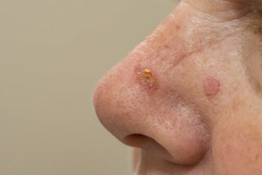 actinic keratosis