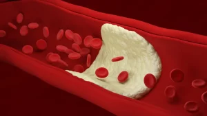 Atherosclerosis. Red blood cells. Artery. Build up of plaque -
