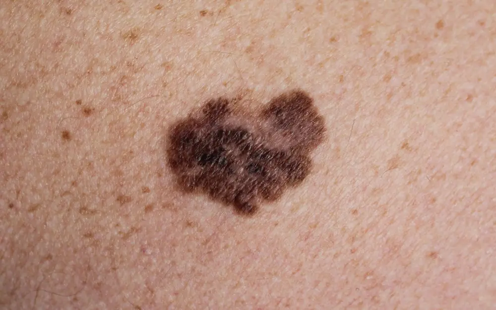 melanoma on light skin