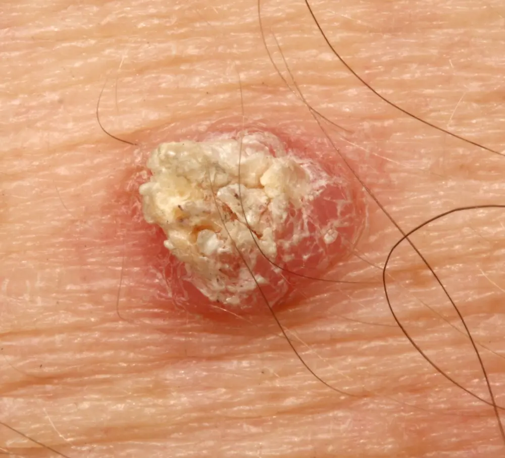 squamous cell carcinoma