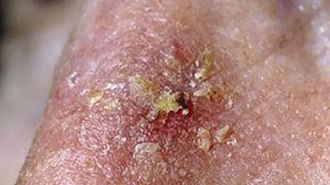 التقرن الشعاعى - احد انواع بقع سرطان الجلد
