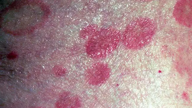 الفُطار الفطراني - احد انواع بقع سرطان الجلد
