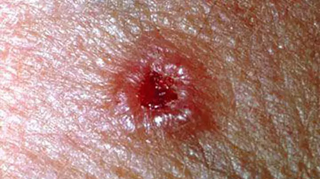 سرطان الخلايا القاعدية - احد انواع سرطان الجلد