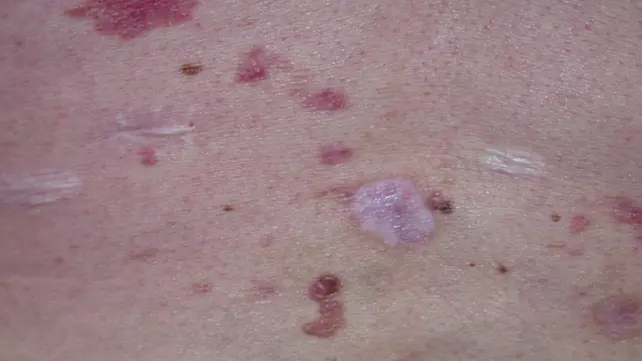 متلازمة وحمة الخلايا القاعدية - احد انواع بقع سرطان الجلد

